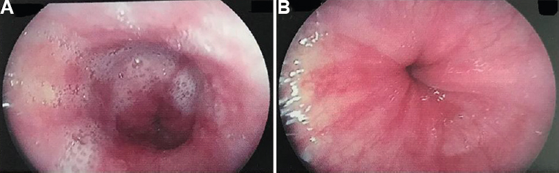(A) Upper gastrointestinal endoscopy showing dilated oesophagus and (B) pooled secretions with tight lower oesophageal sphincter.